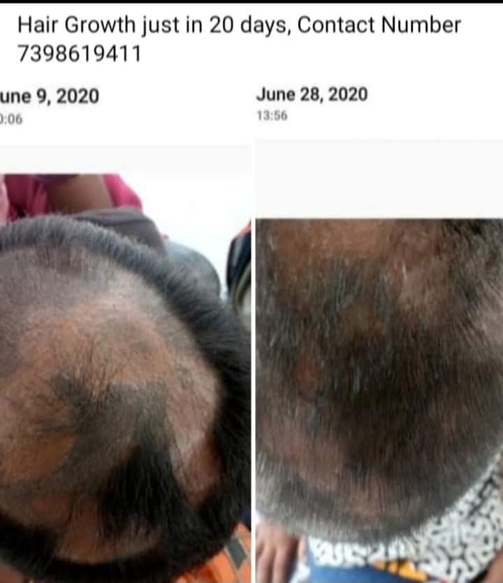 Severe Hair Thinning Treatment