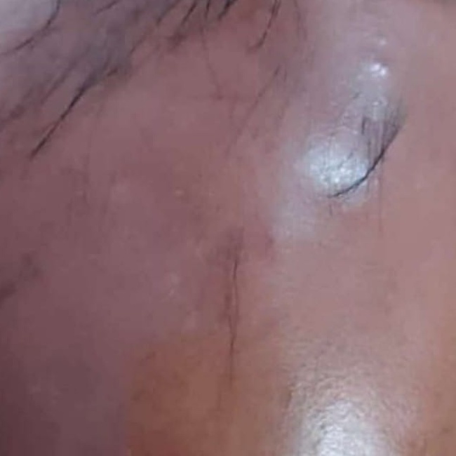Before Treatment
