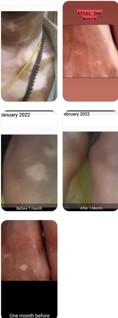 Skin & Hair Conditions (चर्म व केश रोग)